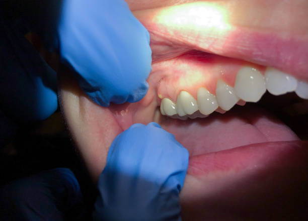 Best Broken Tooth Emergency  in Florence, MS